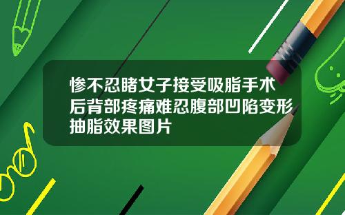 惨不忍睹女子接受吸脂手术后背部疼痛难忍腹部凹陷变形抽脂效果图片