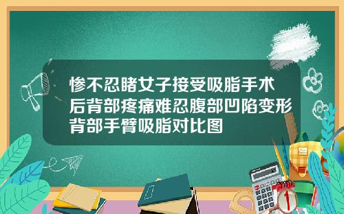 惨不忍睹女子接受吸脂手术后背部疼痛难忍腹部凹陷变形背部手臂吸脂对比图
