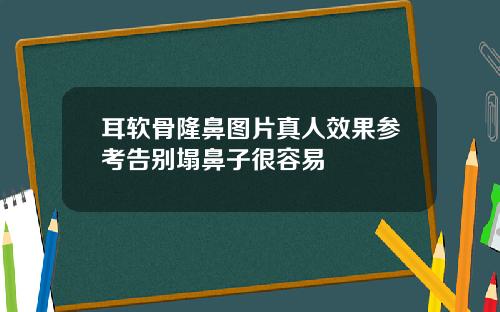 耳软骨隆鼻图片真人效果参考告别塌鼻子很容易