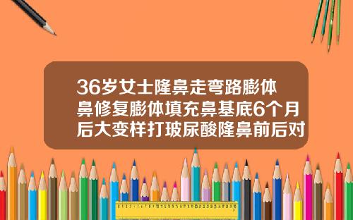 36岁女士隆鼻走弯路膨体鼻修复膨体填充鼻基底6个月后大变样打玻尿酸隆鼻前后对比