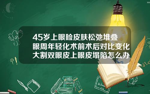 45岁上眼睑皮肤松弛堆叠眼周年轻化术前术后对比变化大割双眼皮上眼皮塌陷怎么办