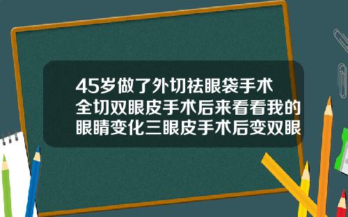 45岁做了外切祛眼袋手术全切双眼皮手术后来看看我的眼睛变化三眼皮手术后变双眼皮前后对比