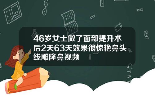 46岁女士做了面部提升术后2天63天效果很惊艳鼻头线雕隆鼻视频
