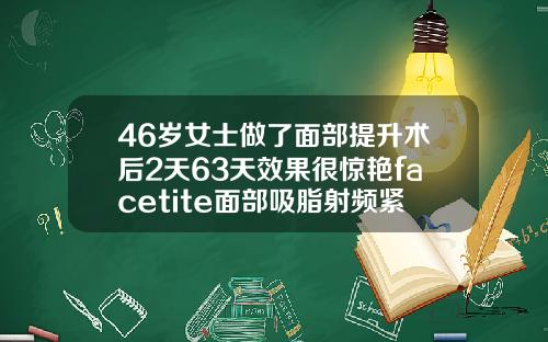 46岁女士做了面部提升术后2天63天效果很惊艳facetite面部吸脂射频紧肤多久自然