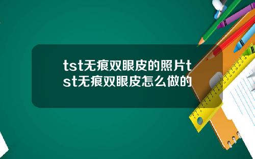 tst无痕双眼皮的照片tst无痕双眼皮怎么做的